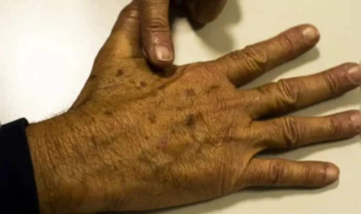 Mutirão para prevenção ao câncer de pele acontece em Salvador