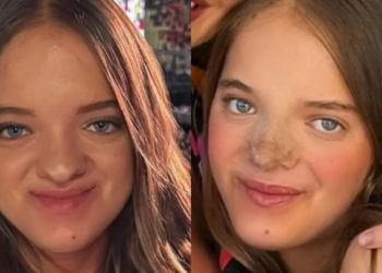 Filha de Ticiane Pinheiro e Roberto Justus passa por rinoplastia aos 14 anos